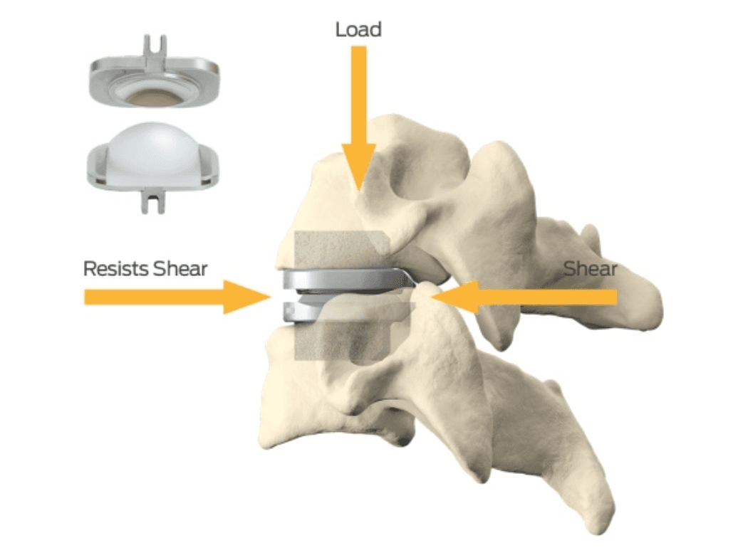 Illustration of an artificial disc implant preserving spinal motion