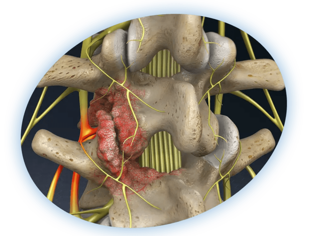 Illustration of a vertebroplasty procedure on a vertebral compression fracture