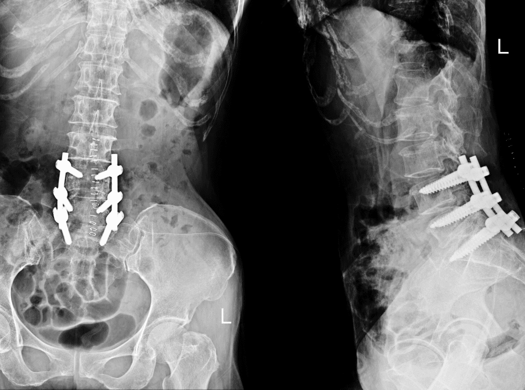 Surgical team performing a lumbar laminectomy procedure