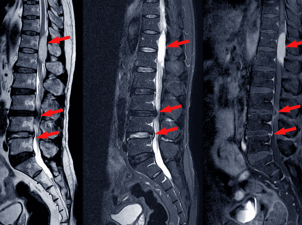 Illustration of a narrowed spinal canal compressing nearby nerves