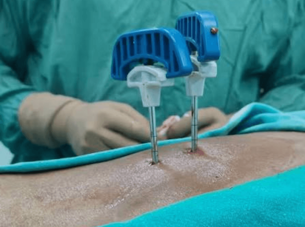 Illustration of a vertebroplasty procedure on a vertebral compression fracture